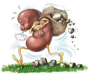 kidney-stones.jpg