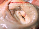 Митральный стеноз stenosisostiiatrioventricularissinistri